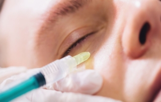 Osocze bogatopłytkowe pod oczy jest podawane za pomocą igły w okolicę skóry.