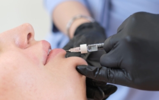 Osoba w rękawiczkach wykonuje powiększanie ust kwasem hialuronowym.