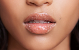 Zbliżenie na usta po zabiegu powiększania ust.